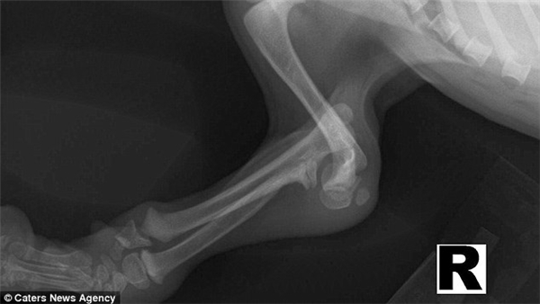  Ảnh chụp X-quang cho thấy phần xương gánh bị cong của Wanda, thứ đã khiến bé suýt thì bị ɡɪᴇ̂́т khi chỉ mới 4 tháng tuổi.