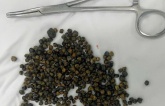Mổ ở Mỹ thất bại, nữ Việt kiều được bác sĩ tại TPHCM lấy ra 481 viên sỏi mật Mổ ở Mỹ thất bại, nữ Việt kiều được bác sĩ tại TPHCM lấy ra 481 viên sỏi mật