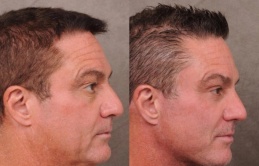 Nam giới Thung lũng Silicon chi trăm nghìn USD 'căng da' vì sợ hết thời Nam giới Thung lũng Silicon chi trăm nghìn USD 'căng da' vì sợ hết thời