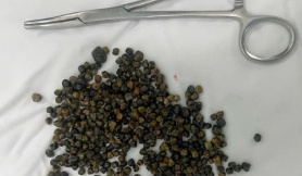 Mổ ở Mỹ thất bại, nữ Việt kiều được bác sĩ tại TPHCM lấy ra 481 viên sỏi mật