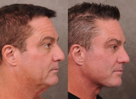 Nam giới Thung lũng Silicon chi trăm nghìn USD 'căng da' vì sợ hết thời Nam giới Thung lũng Silicon chi trăm nghìn USD 'căng da' vì sợ hết thời