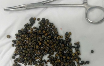 Mổ ở Mỹ thất bại, nữ Việt kiều được bác sĩ tại TPHCM lấy ra 481 viên sỏi mật