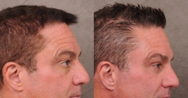 Nam giới Thung lũng Silicon chi trăm nghìn USD 'căng da' vì sợ hết thời Nam giới Thung lũng Silicon chi trăm nghìn USD 'căng da' vì sợ hết thời